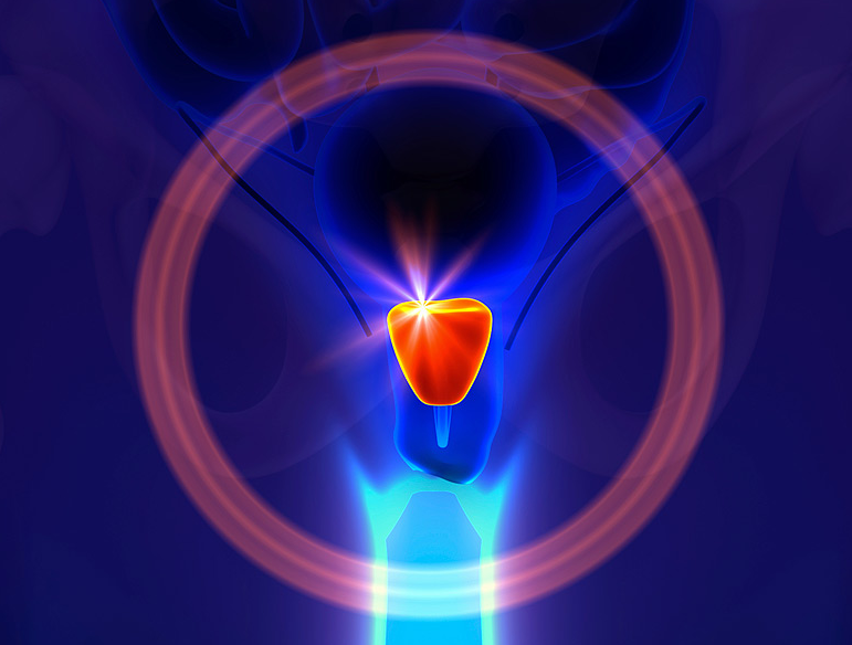 前列腺肥大,阜阳前列腺肥大,阜阳前列腺肥大原因