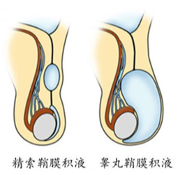 鞘膜积液危害,鞘膜积液治疗,阜阳鞘膜积液医院