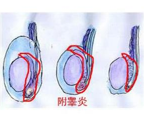 附睾炎,附睾炎症状,阜阳阜亚医院