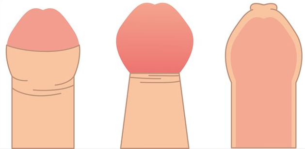 包茎,阜阳包茎医院,阜阳治疗包茎医院