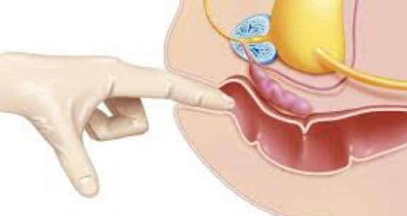 前列腺痛,前列腺痛原因,阜阳前列腺痛原因