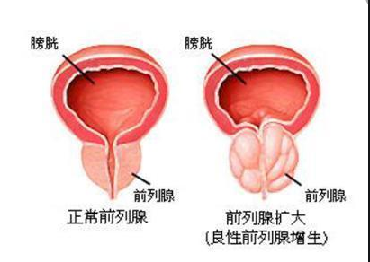 前列腺增生,前列腺增生原因,阜阳前列腺增生原因