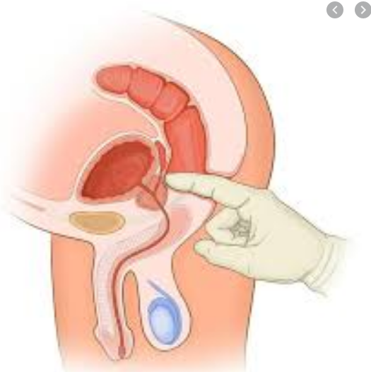 前列腺肥大,前列腺肥大医院,阜阳前列腺肥大医院