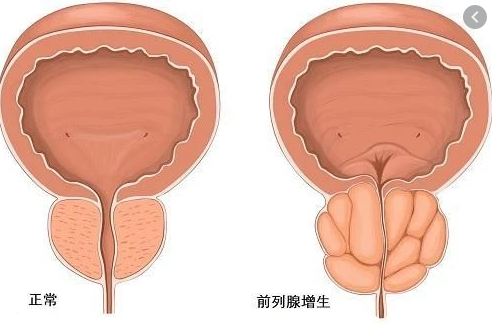 前列腺增生,前列腺增生原因,阜阳前列腺增生原因