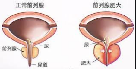 前列腺肥大,前列腺肥大原因,阜阳前列腺肥大原因